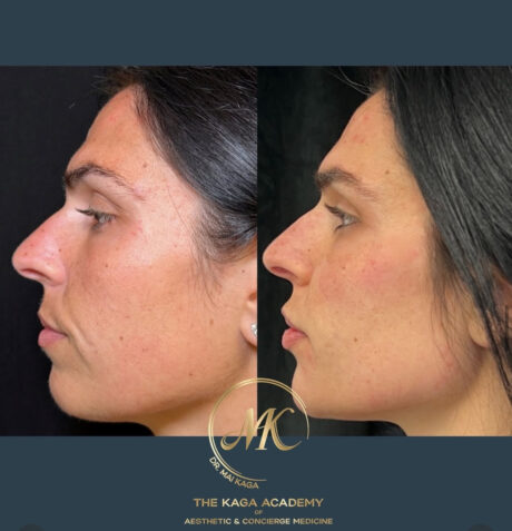 4Point Lift case #4553