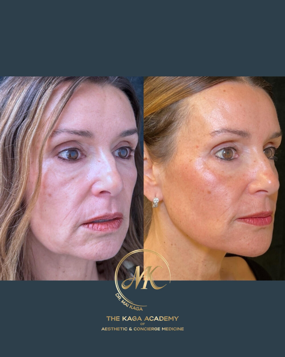 Halo Laser/ Laser Skin Resurfacing case #4710