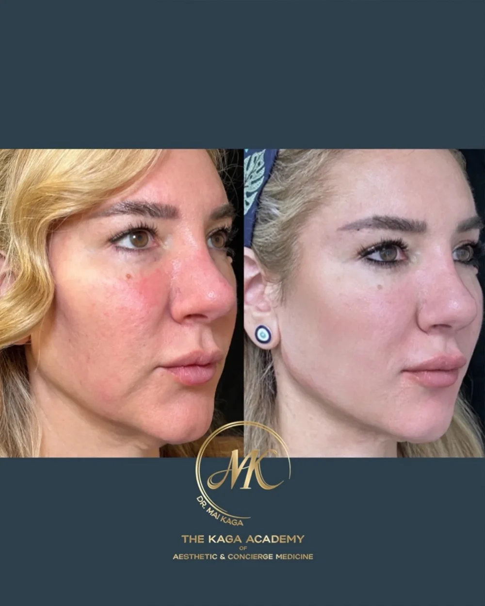 4Point Lift case #5241